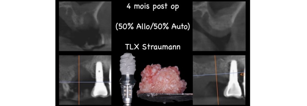 Chirurgie pré-implantaire