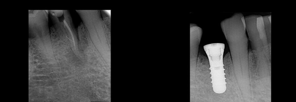 Chirurgie Implantaire