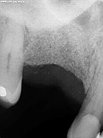 Chirurgie pré-implantaire