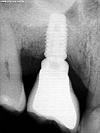 Chirurgie pré-implantaire