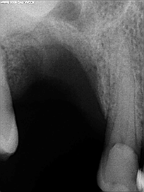 Chirurgie pré-implantaire