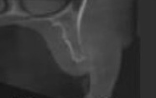 Chirurgie pré-implantaire