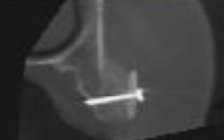 Chirurgie pré-implantaire