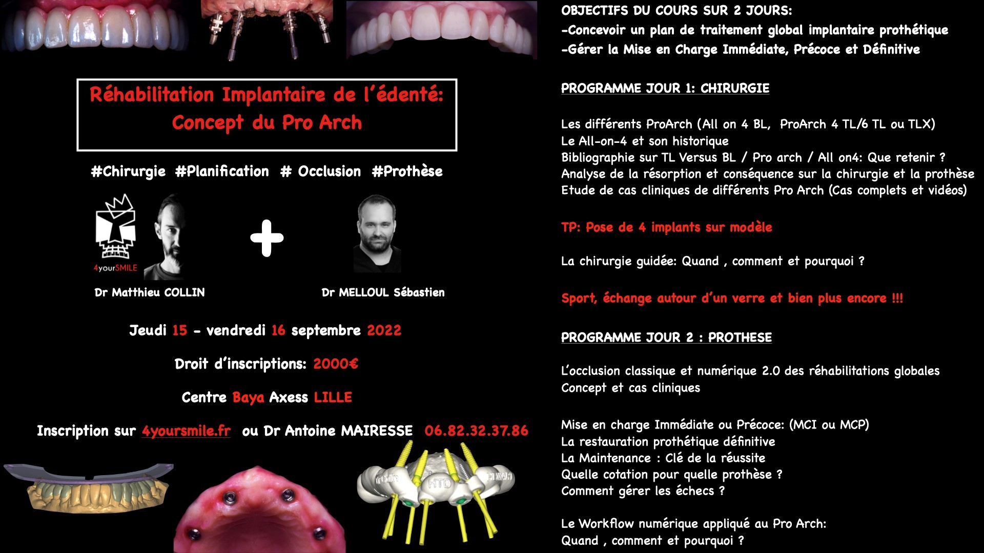 Réhabilitation de l'édenté complet: Concept du Pro Arch à LILLE