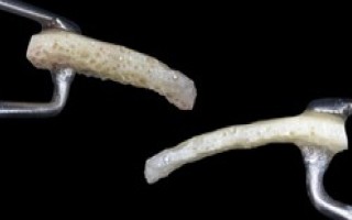 Chirurgie pré-implantaire